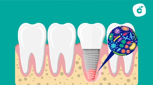 infección en implante dental