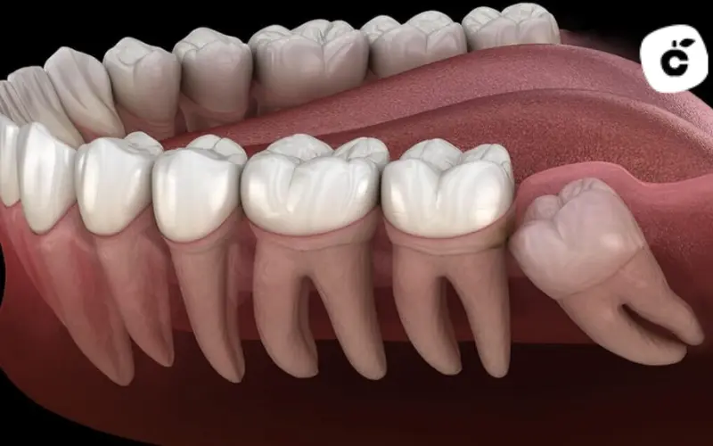 muela del juicio infectada