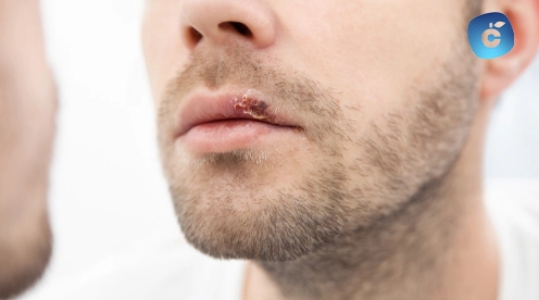 que es un herpes labial