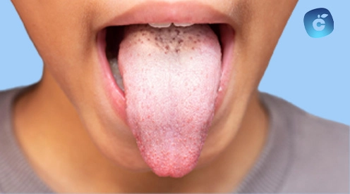 Candidiasis bucal (1)