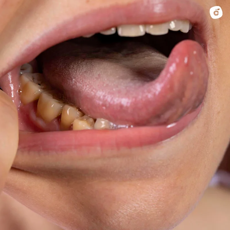 Caries dentales, infecciones