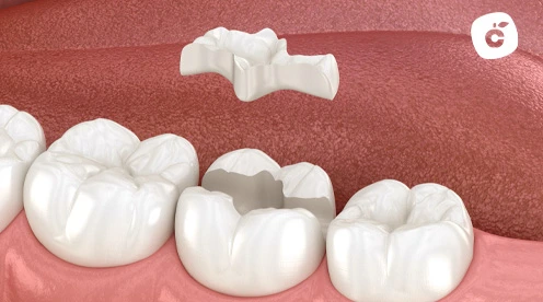 Incrustación dental