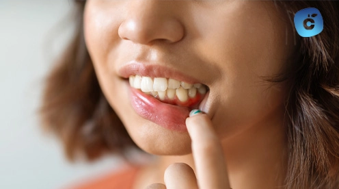 Inflamación de encías