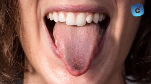 Inflamacón papilas gustativas