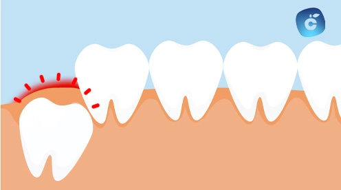 Muela del juicio saliendo