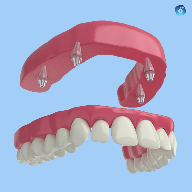 Una prótesis híbrida sobre implantes dentales