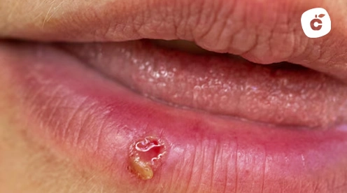 Calenturas en los labios