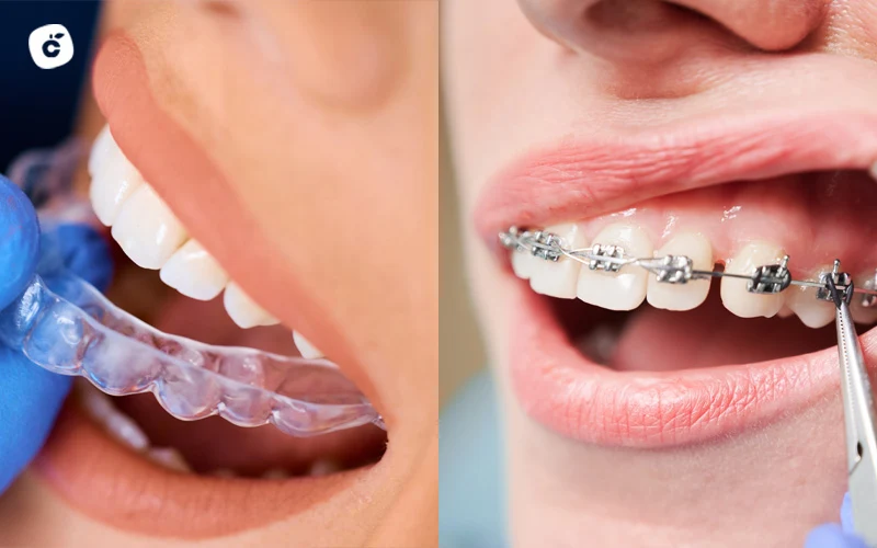Ortodoncia invisible o brackets