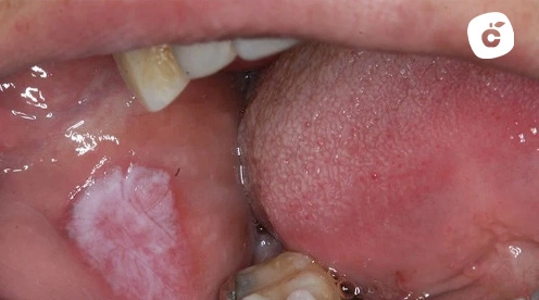 liquen oral