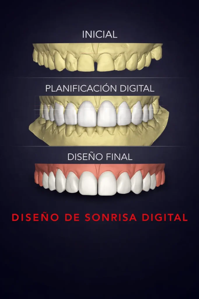 Diseño de sonrisa resultado completo