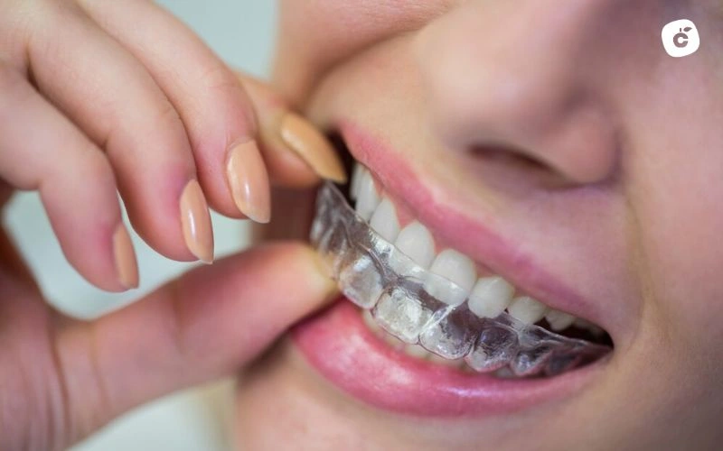 Alineadores invisibles