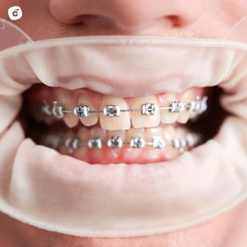 Brackets de autoligado