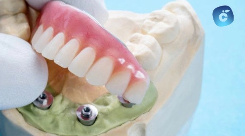 trabajar después de un implante dental