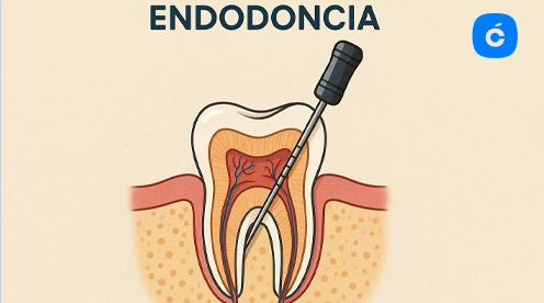 que es una endodoncia