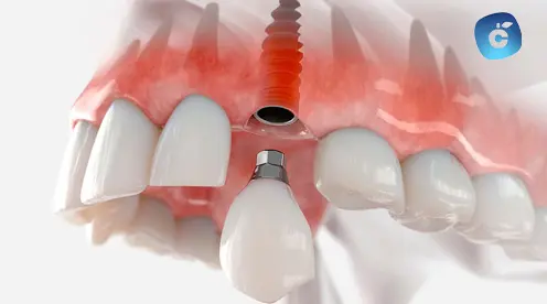 rechazo implante dental