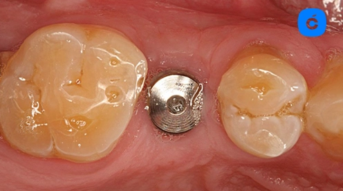 se me ve el tornillo del implante dental