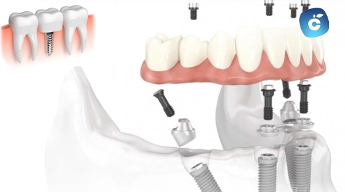 implantes de carga inmediata