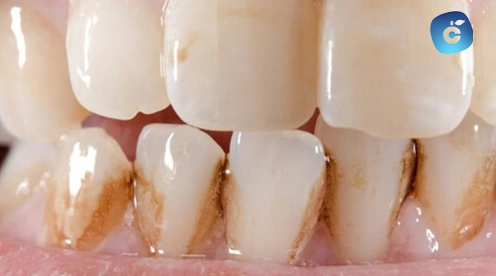 sarro en los dientes de abajo