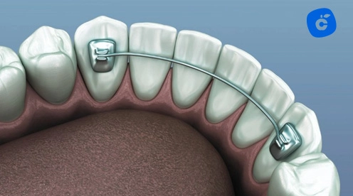 retenedor dental