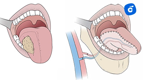 Glosectomia