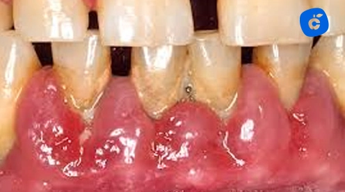 Hiperplasia gingival