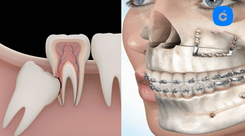 cirugia oral vs maxilofacial