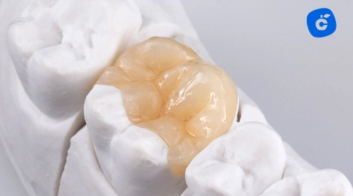 incrustación dental