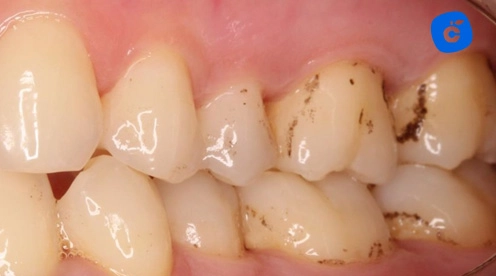 manchas negras dientes