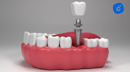 precio implante dental madrid