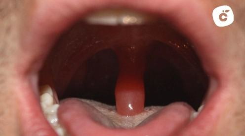 uvula inflamada
