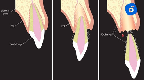 avulsión dental