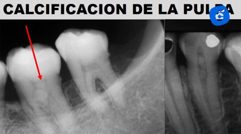 calcificación dental