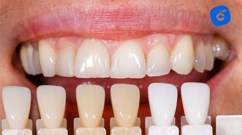 carillas dentales en farmacias