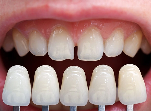 carillas dentales