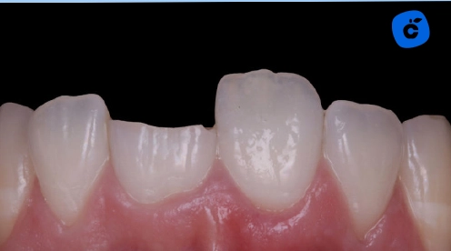 Traumatismo dental