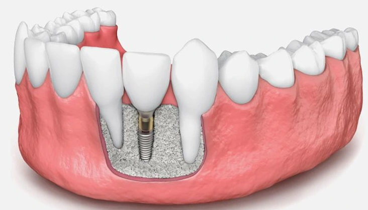 implantes poco hueso