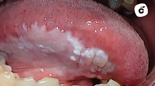 leucoplasia