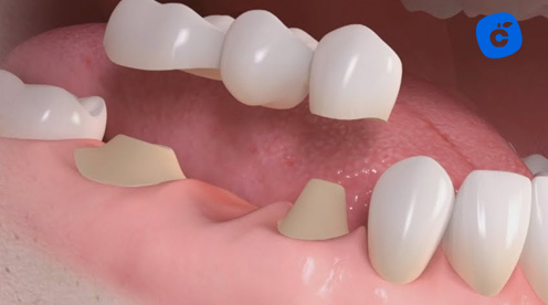 puente dental 3 piezas