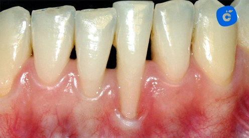 recesión gingival