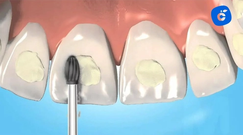resina dental