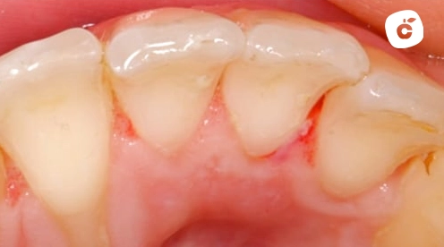 torsion dental