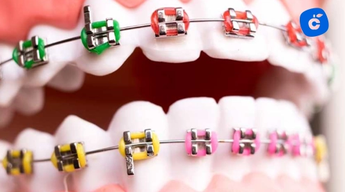 brackets definición