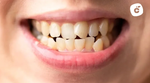 dientes torcidos adultos