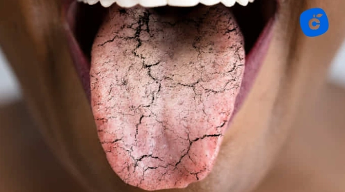 grietas en lengua