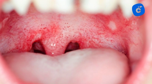 puntos blancos boca adultos