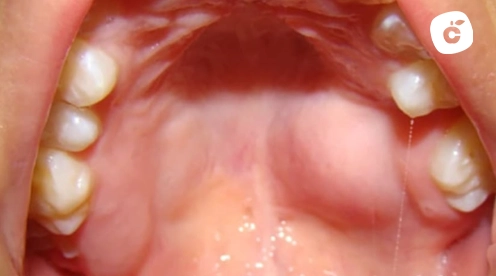 cielo boca inflamado