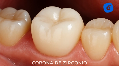 corona zirconio monolitico