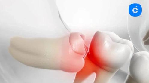 cuanto se tarda en quitar muela juicio