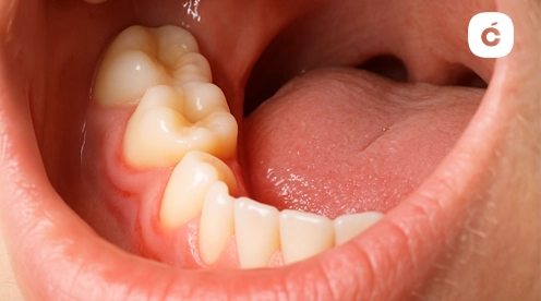 que tomar cuando sacan muela juicio