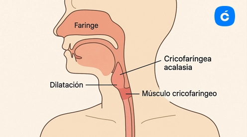 Acalasia Cricofaríngea